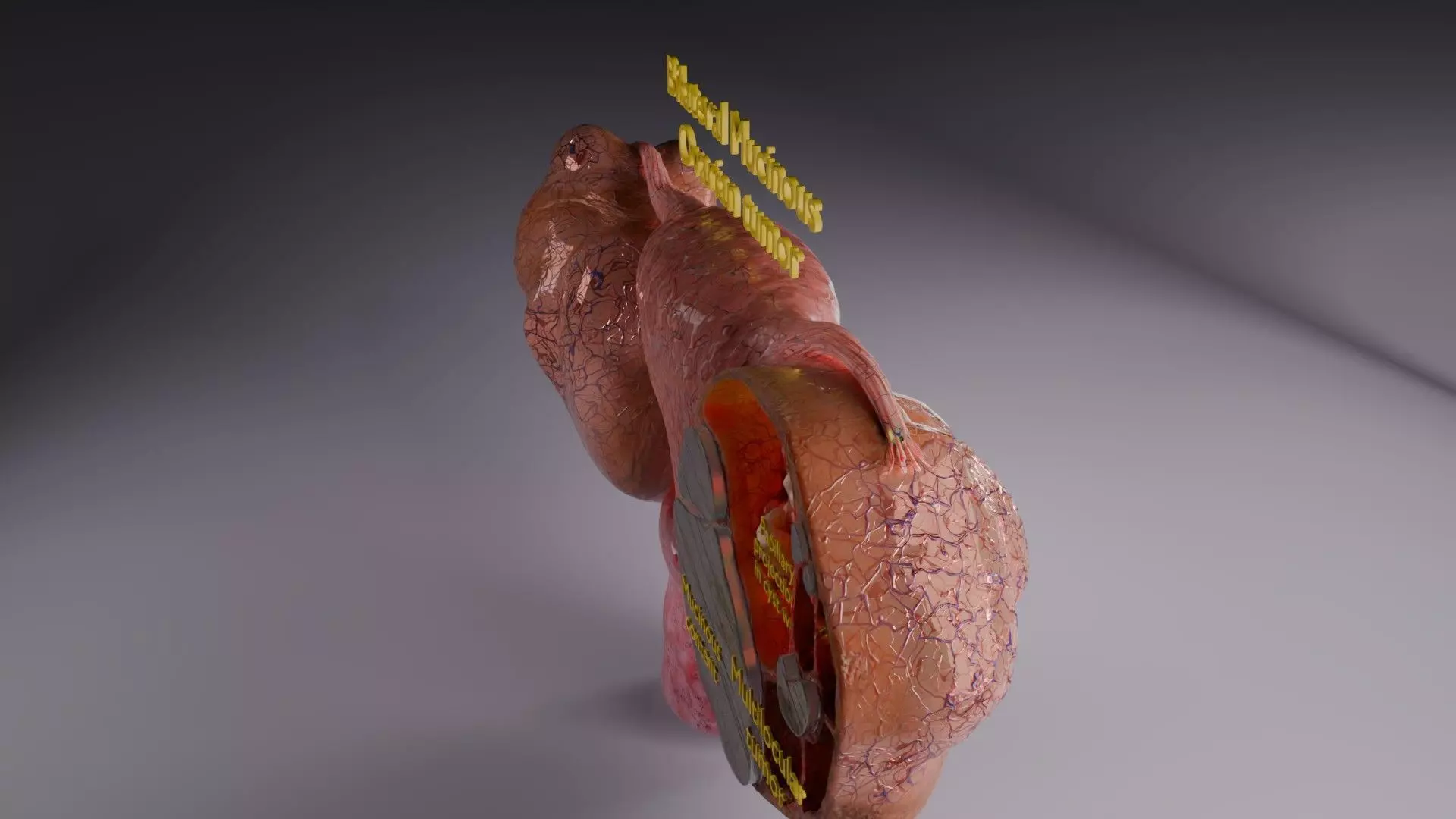 ovary mucinous cystic tumor  Low-poly 3D model_66
