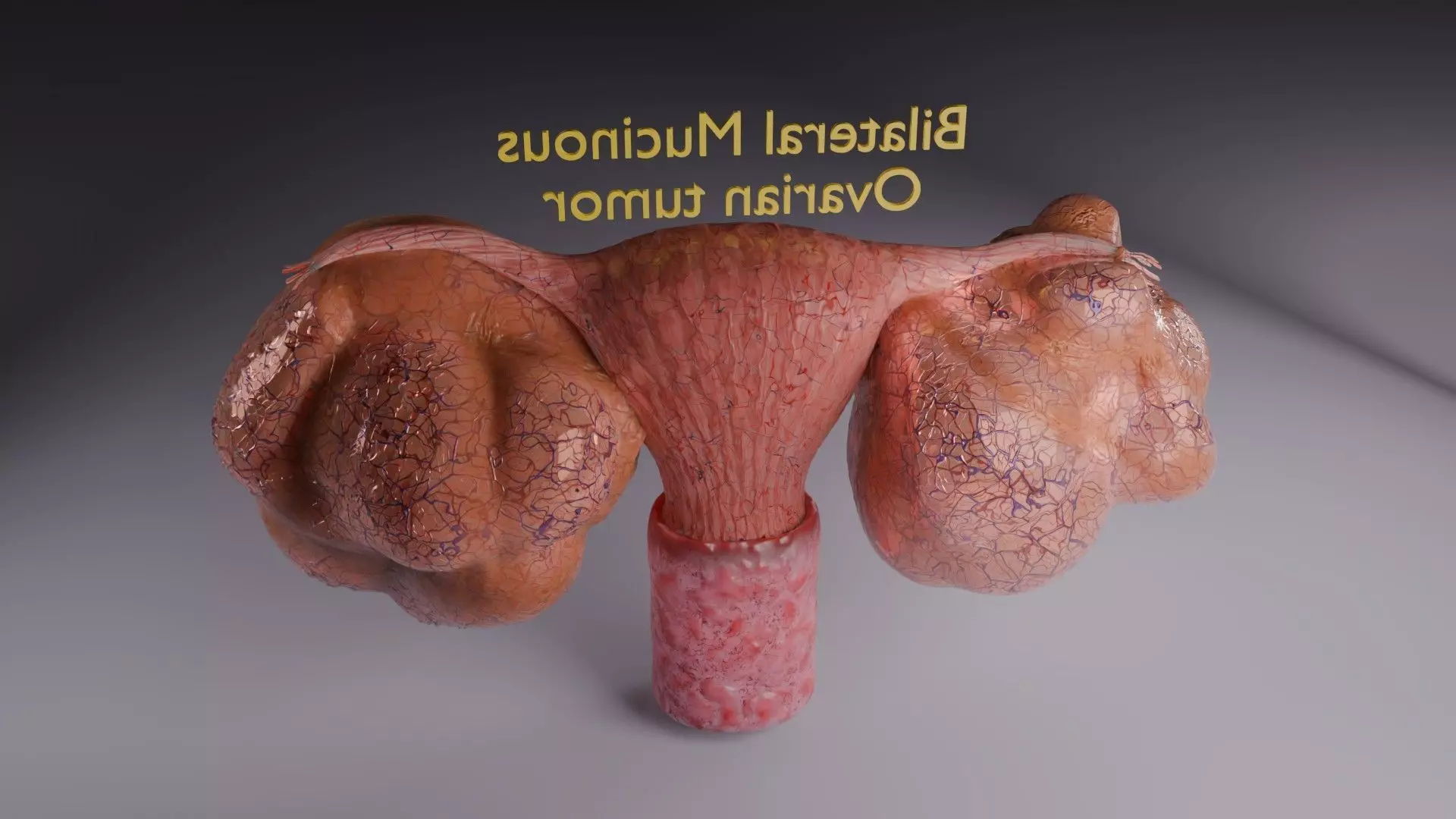 ovary mucinous cystic tumor  Low-poly 3D model_67
