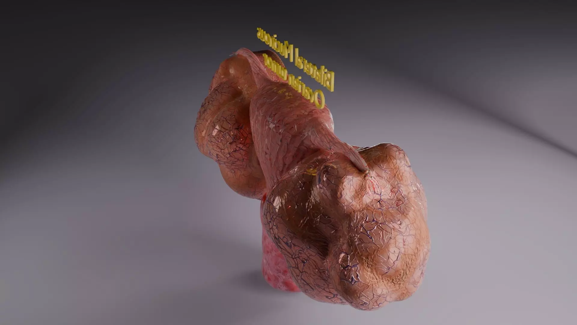 ovary mucinous cystic tumor  Low-poly 3D model_52