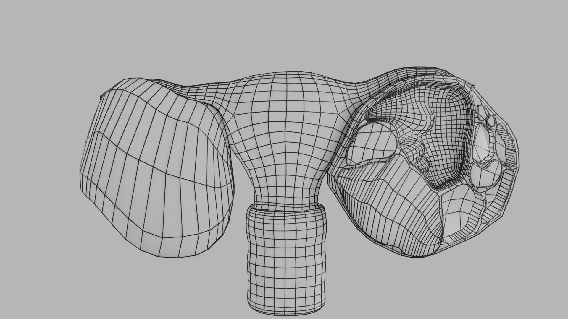 ovary mucinous cystic tumor  Low-poly 3D model_23