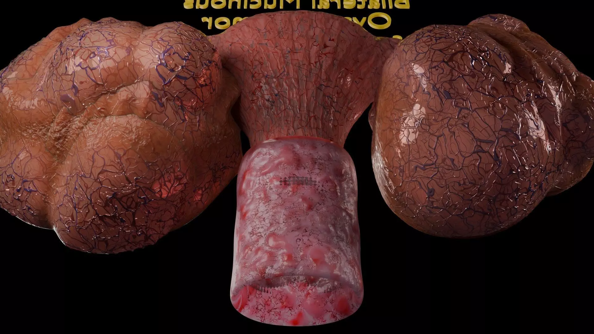 ovary mucinous cystic tumor  Low-poly 3D model_16