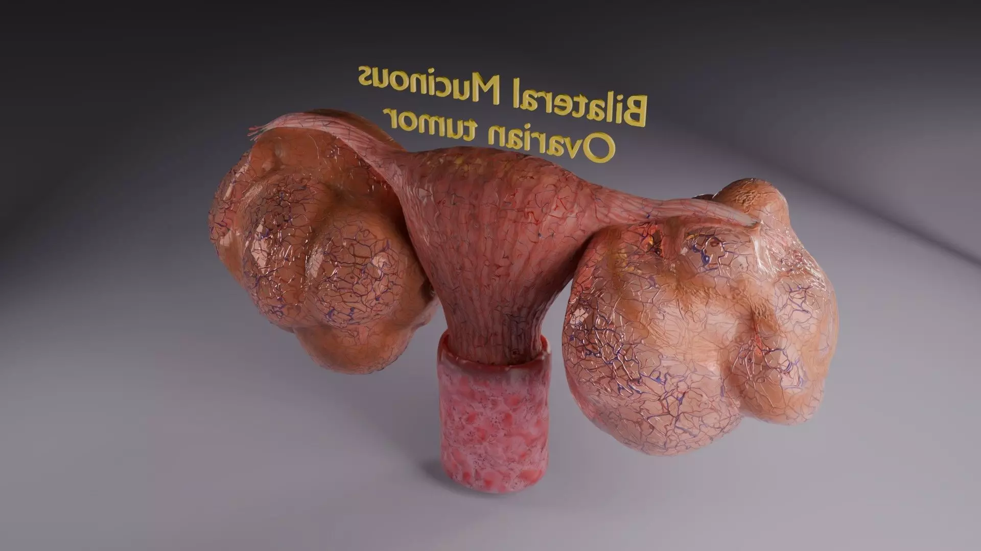 ovary mucinous cystic tumor  Low-poly 3D model_50