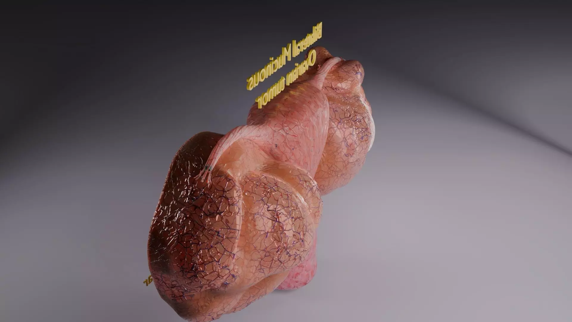 ovary mucinous cystic tumor  Low-poly 3D model_58