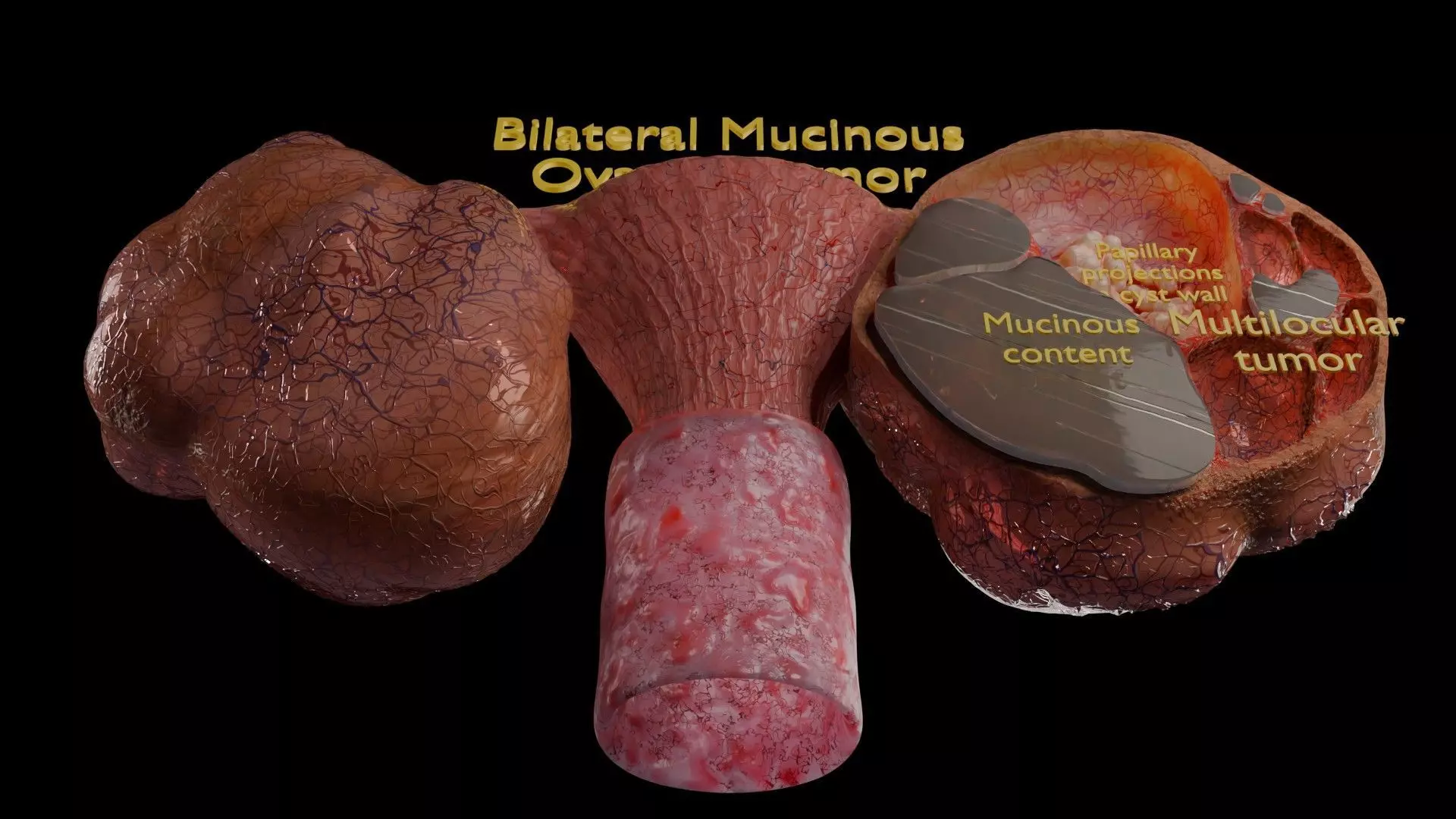 ovary mucinous cystic tumor  Low-poly 3D model_6