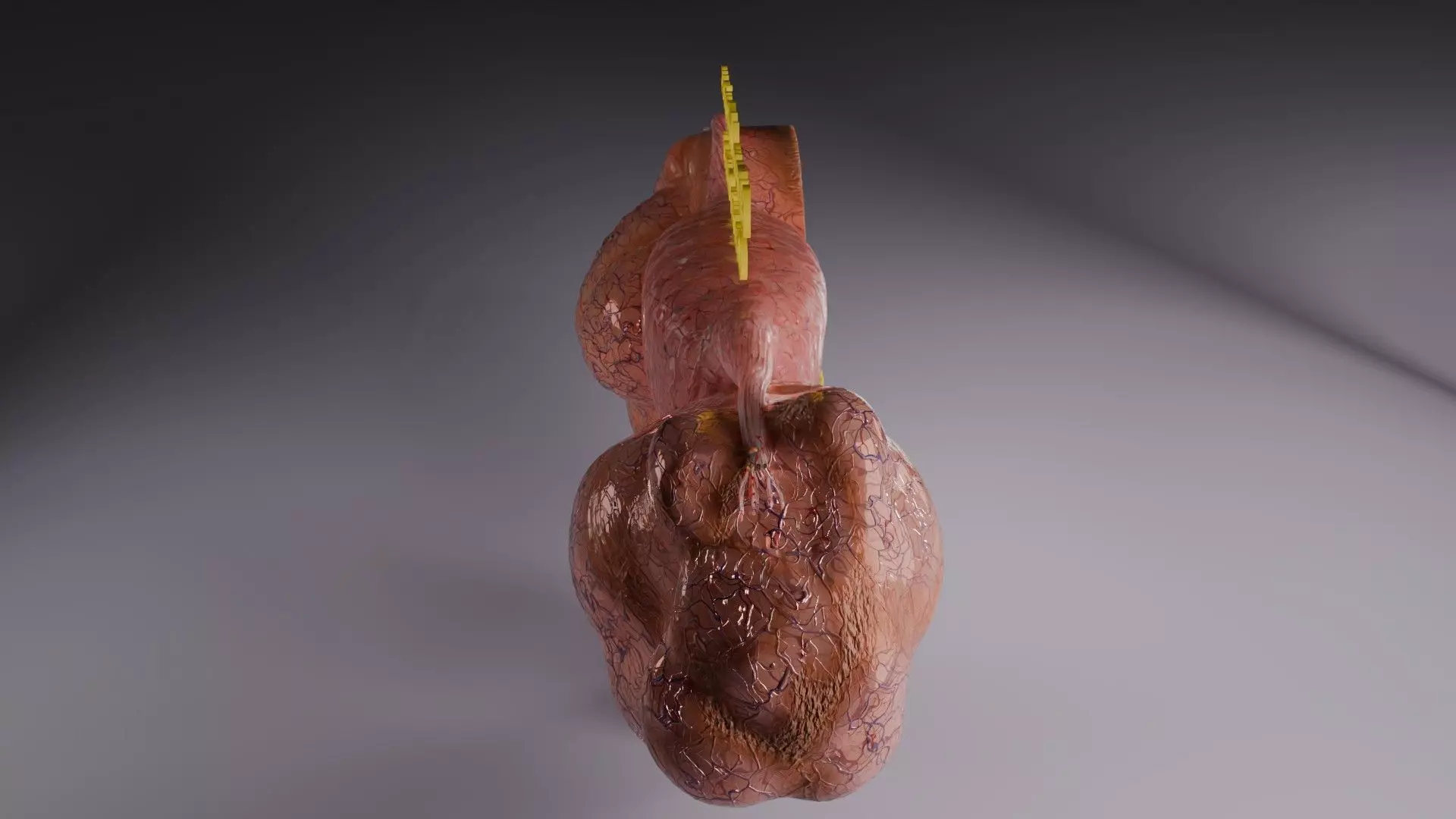ovary mucinous cystic tumor  Low-poly 3D model_44