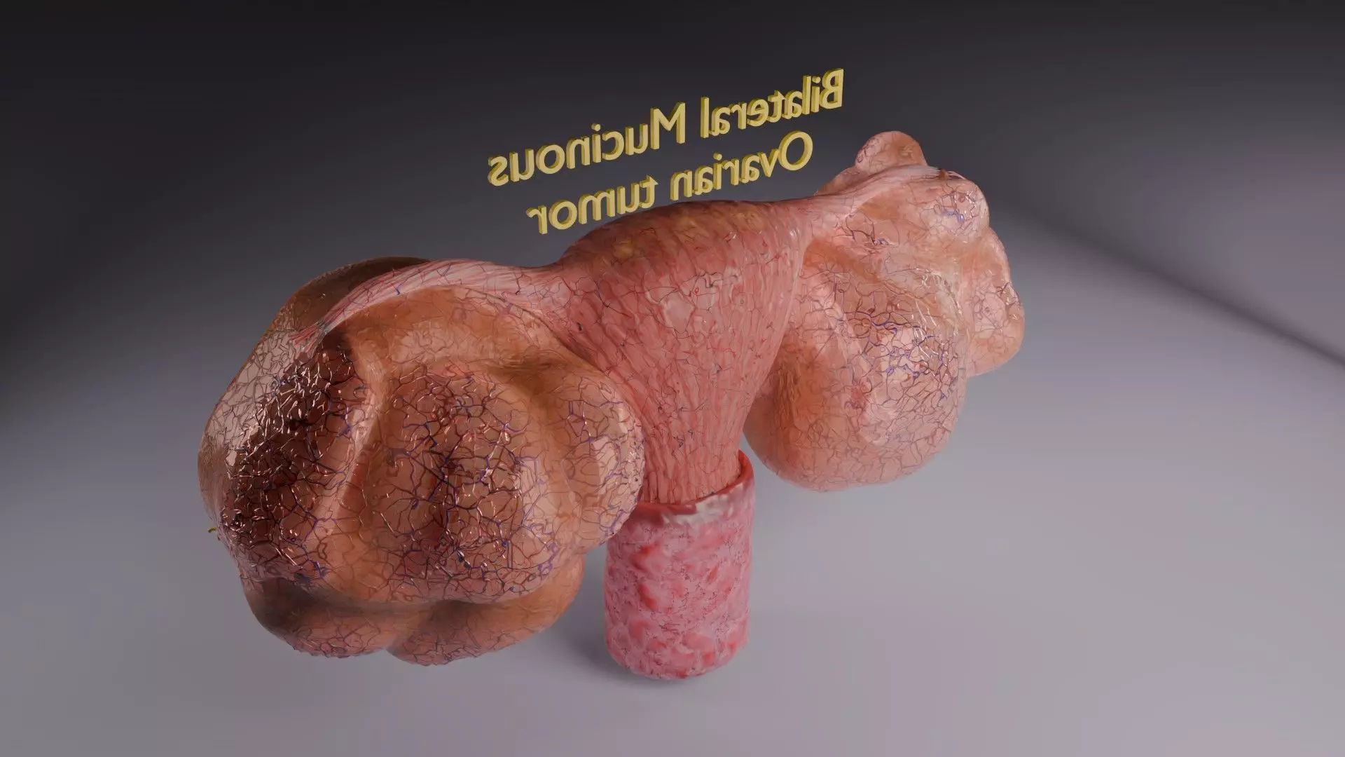 ovary mucinous cystic tumor  Low-poly 3D model_61