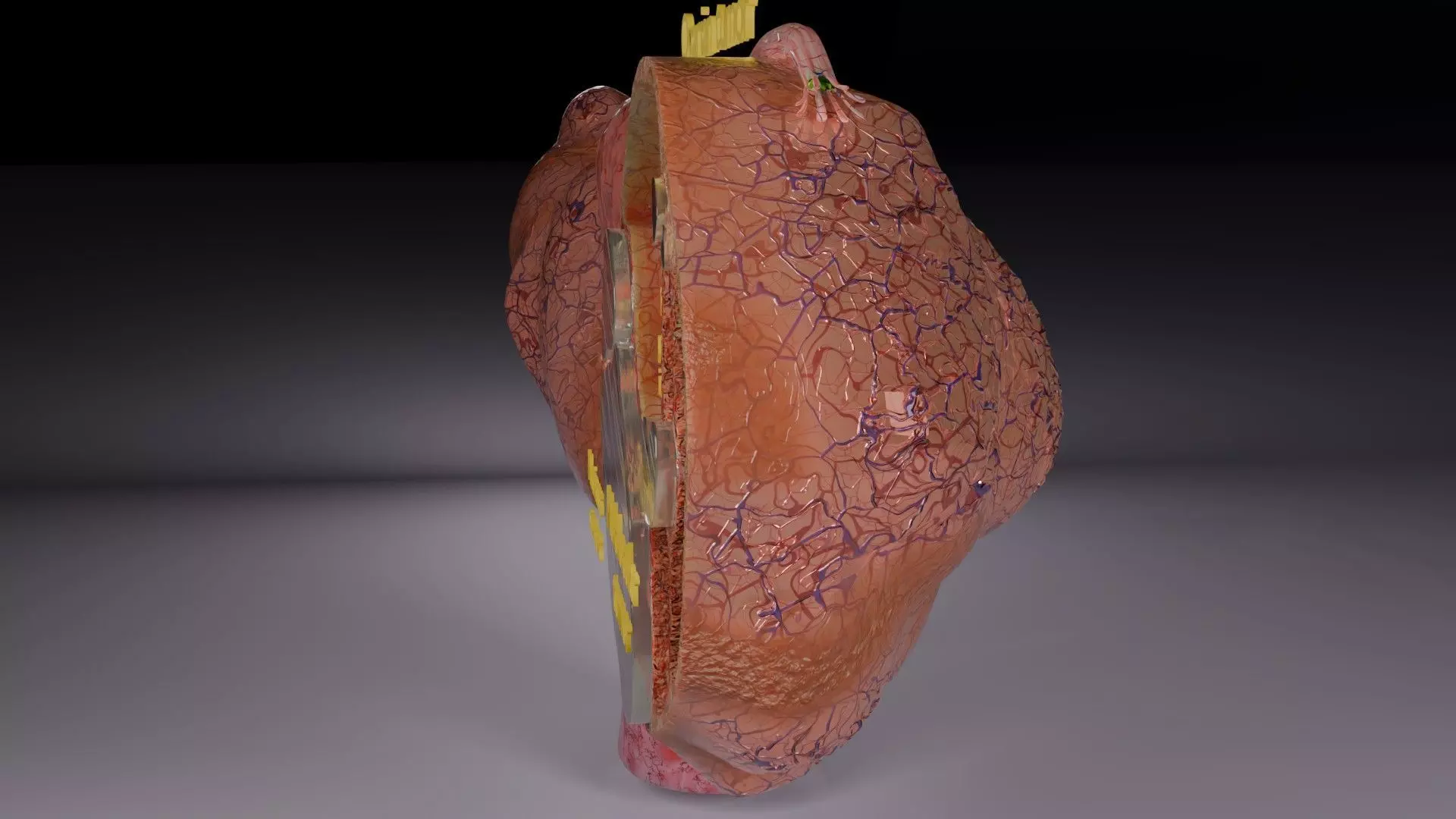 ovary mucinous cystic tumor  Low-poly 3D model_9