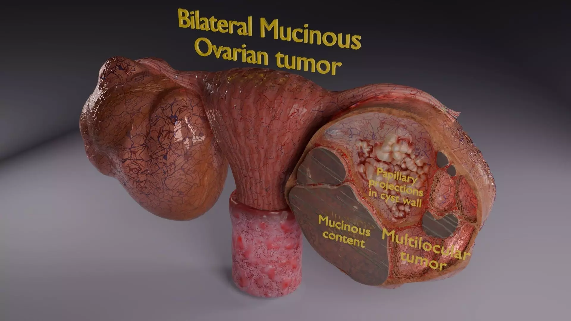 ovary mucinous cystic tumor  Low-poly 3D model_8