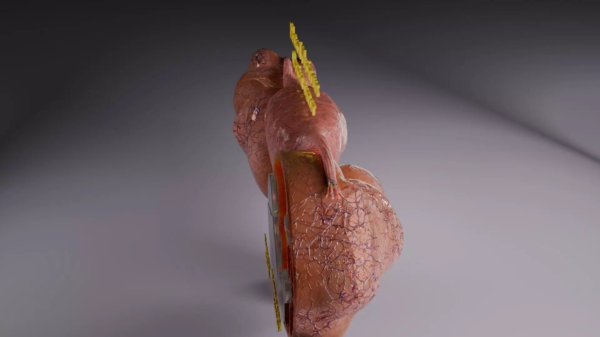 ovary mucinous cystic tumor  Low-poly 3D model_57