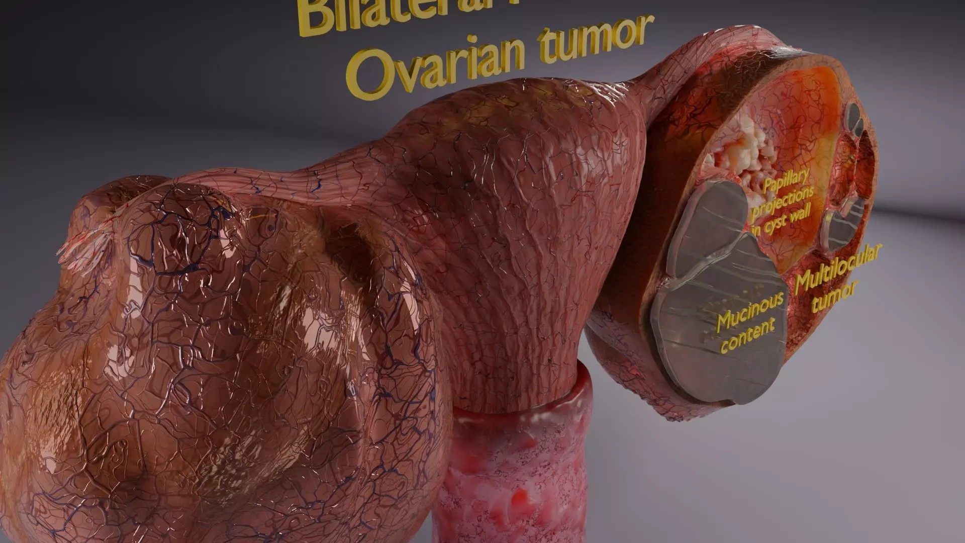 ovary mucinous cystic tumor  Low-poly 3D model_15