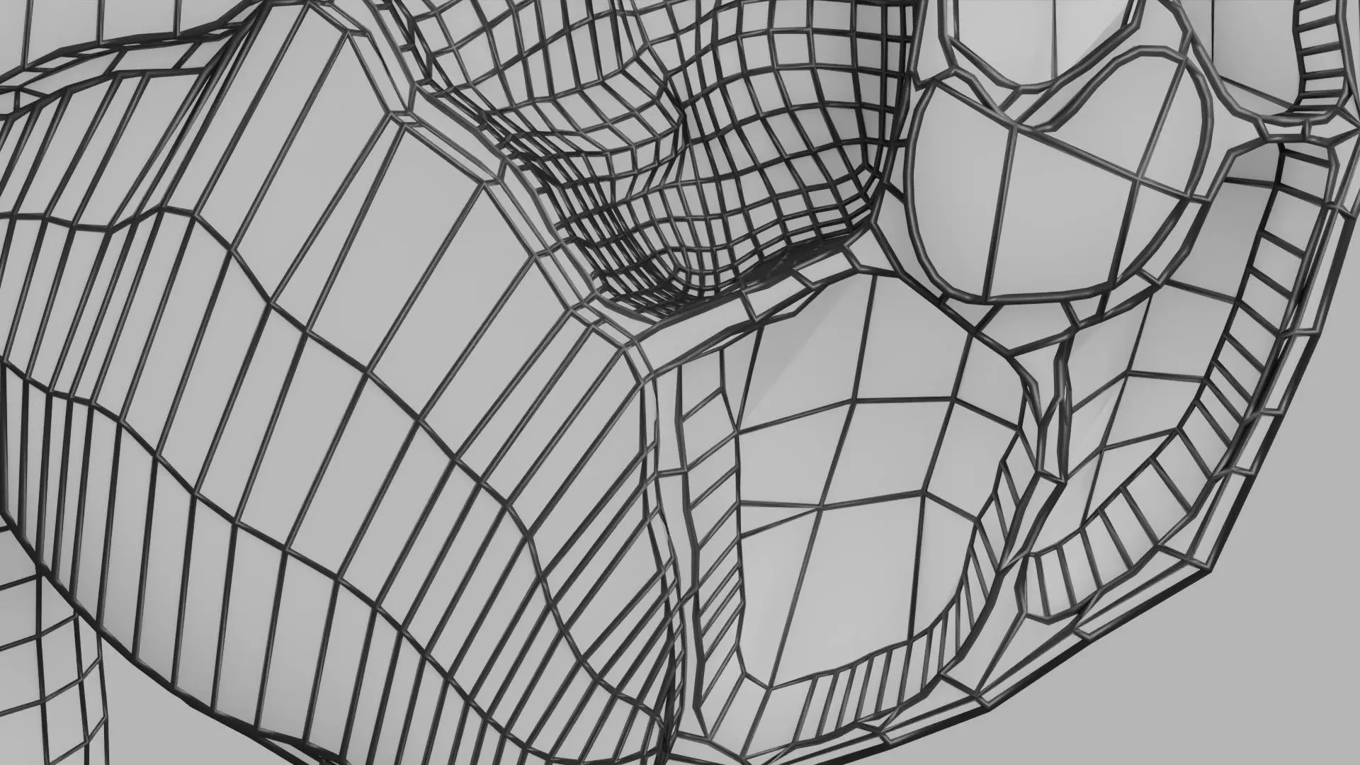ovary mucinous cystic tumor  Low-poly 3D model_26