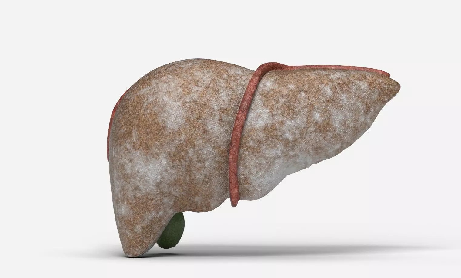 Liver Damage Stages Low-poly 3D model_12