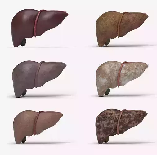 Liver Damage Stages Low-poly 3D model
