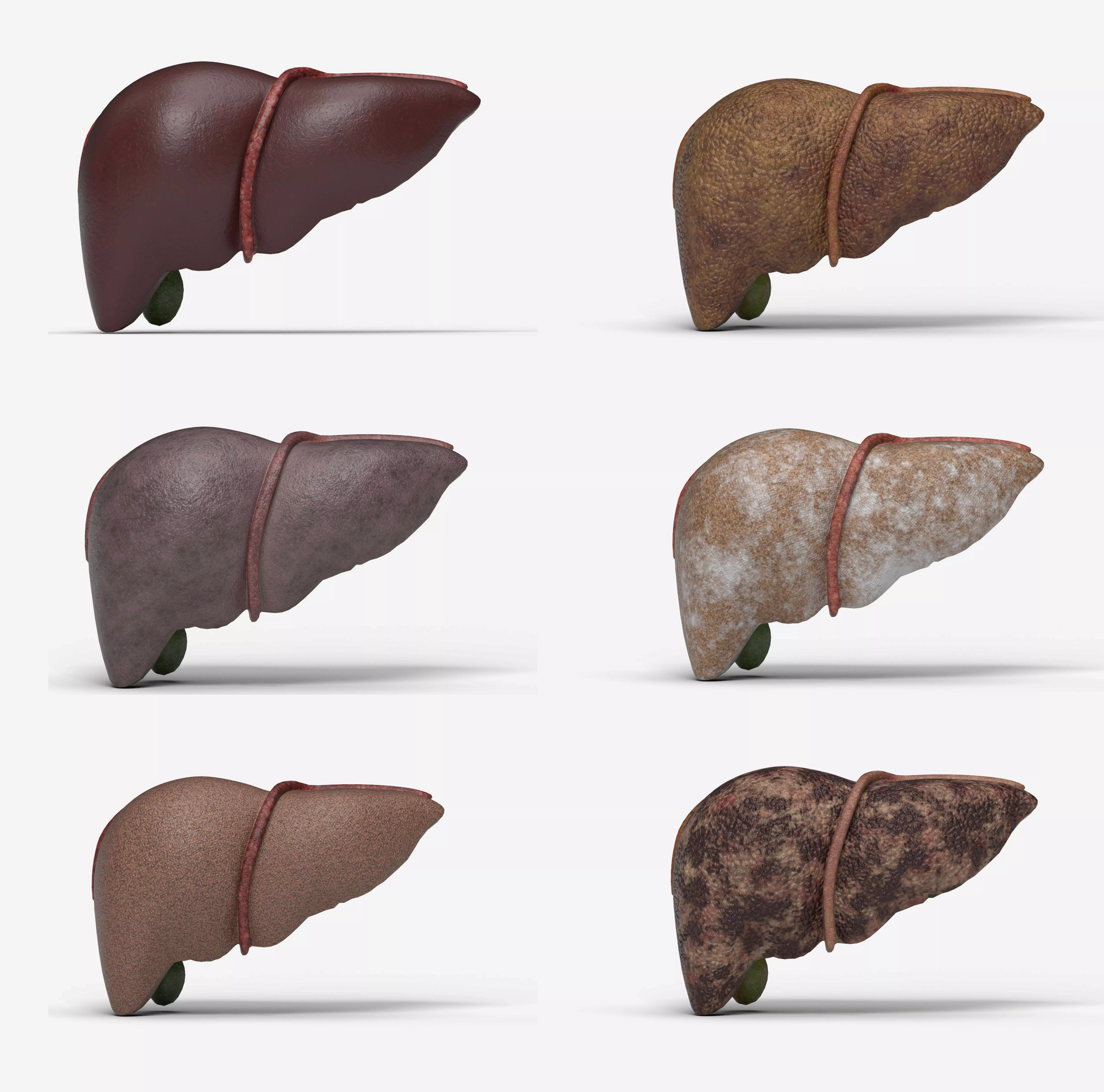 Liver Damage Stages Low-poly 3D model_0