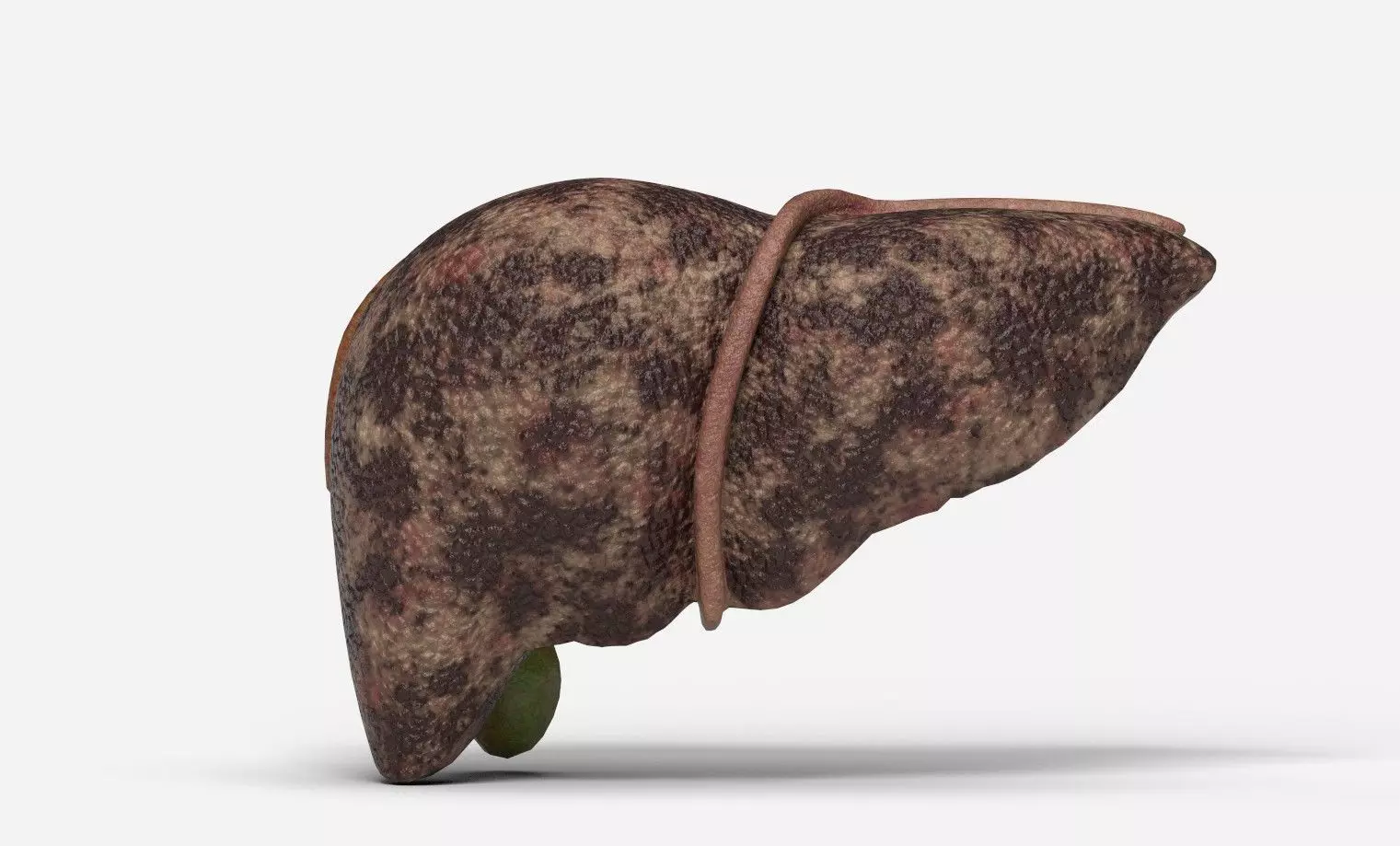 Liver Damage Stages Low-poly 3D model_14