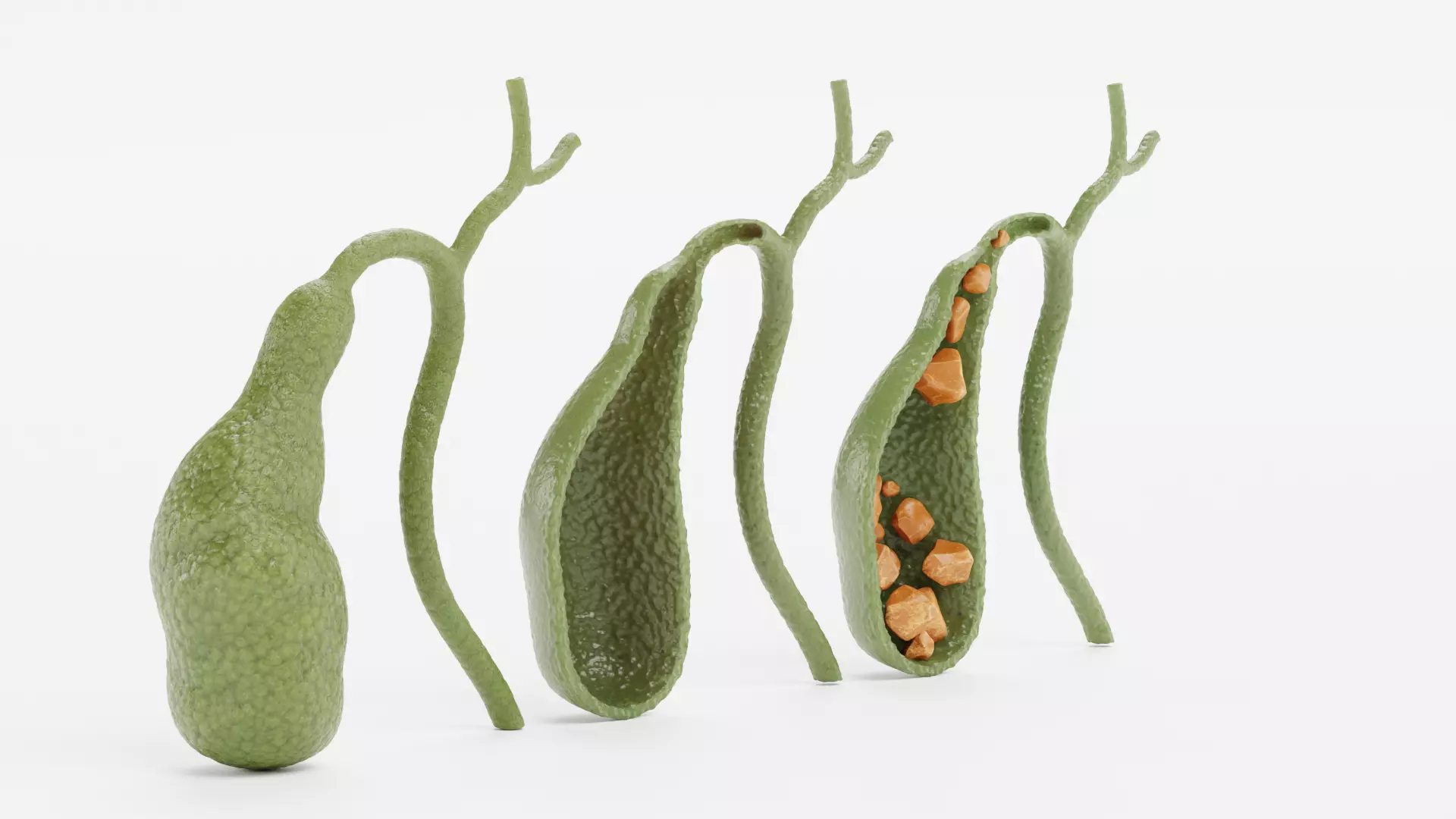 Gallbladder Set - Full Human Organ with Section and Gallstones  3D model_1