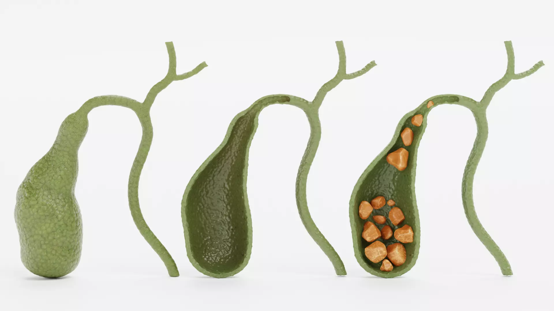 Gallbladder Set - Full Human Organ with Section and Gallstones  3D model_0