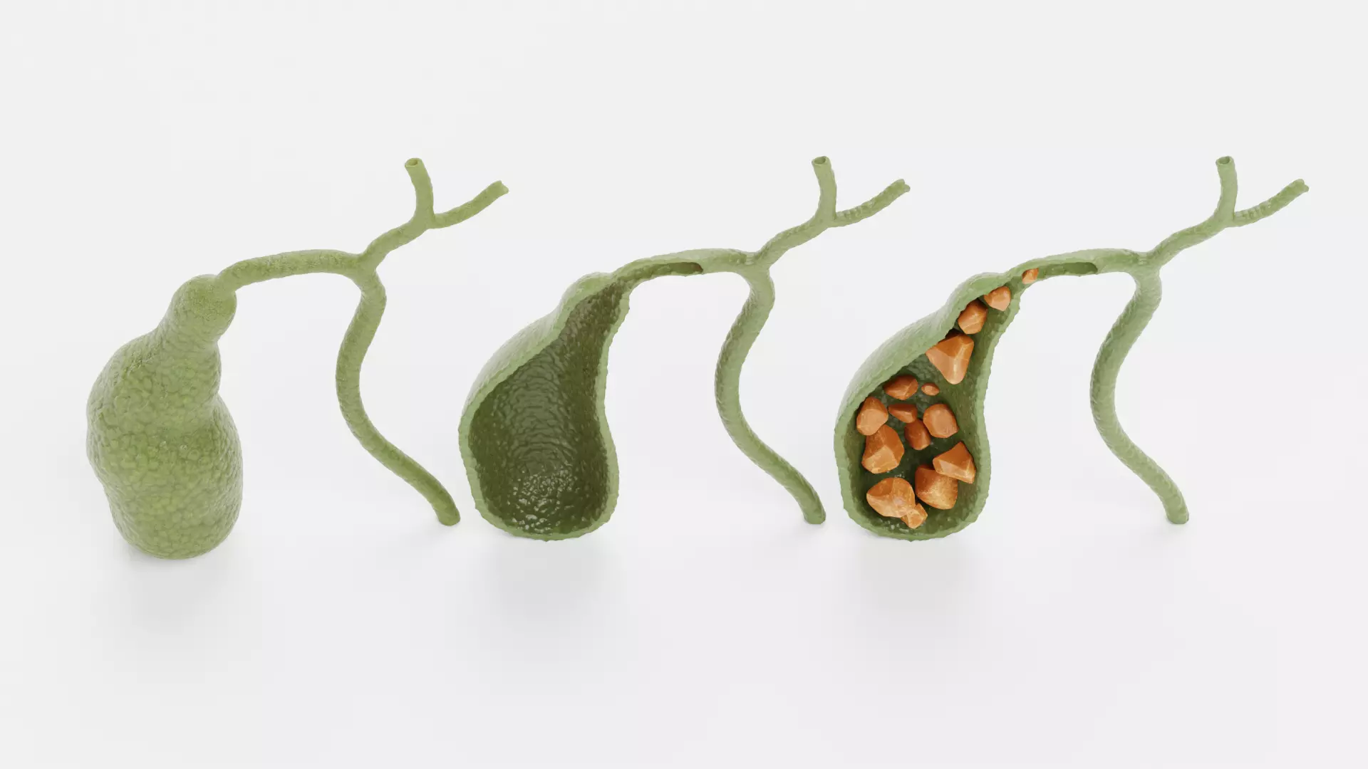 Gallbladder Set - Full Human Organ with Section and Gallstones  3D model_5