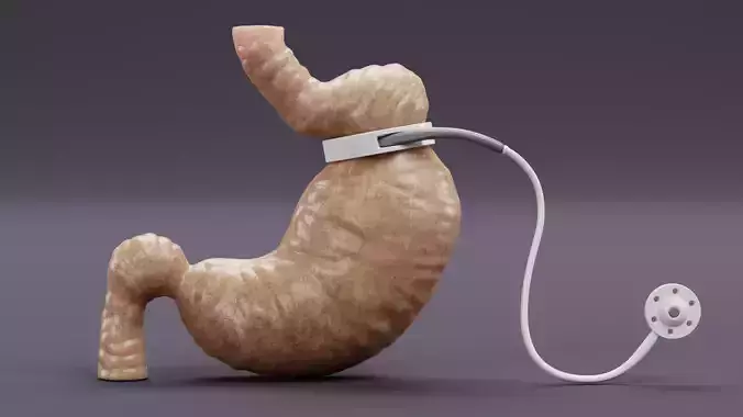 Stomach with Gastric Band - Human Anatomy 3D model