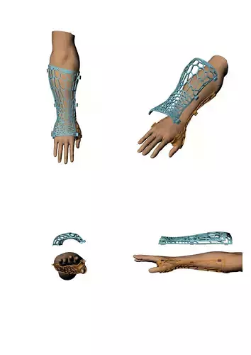 Technology  Medical   on broken arm   3D print model