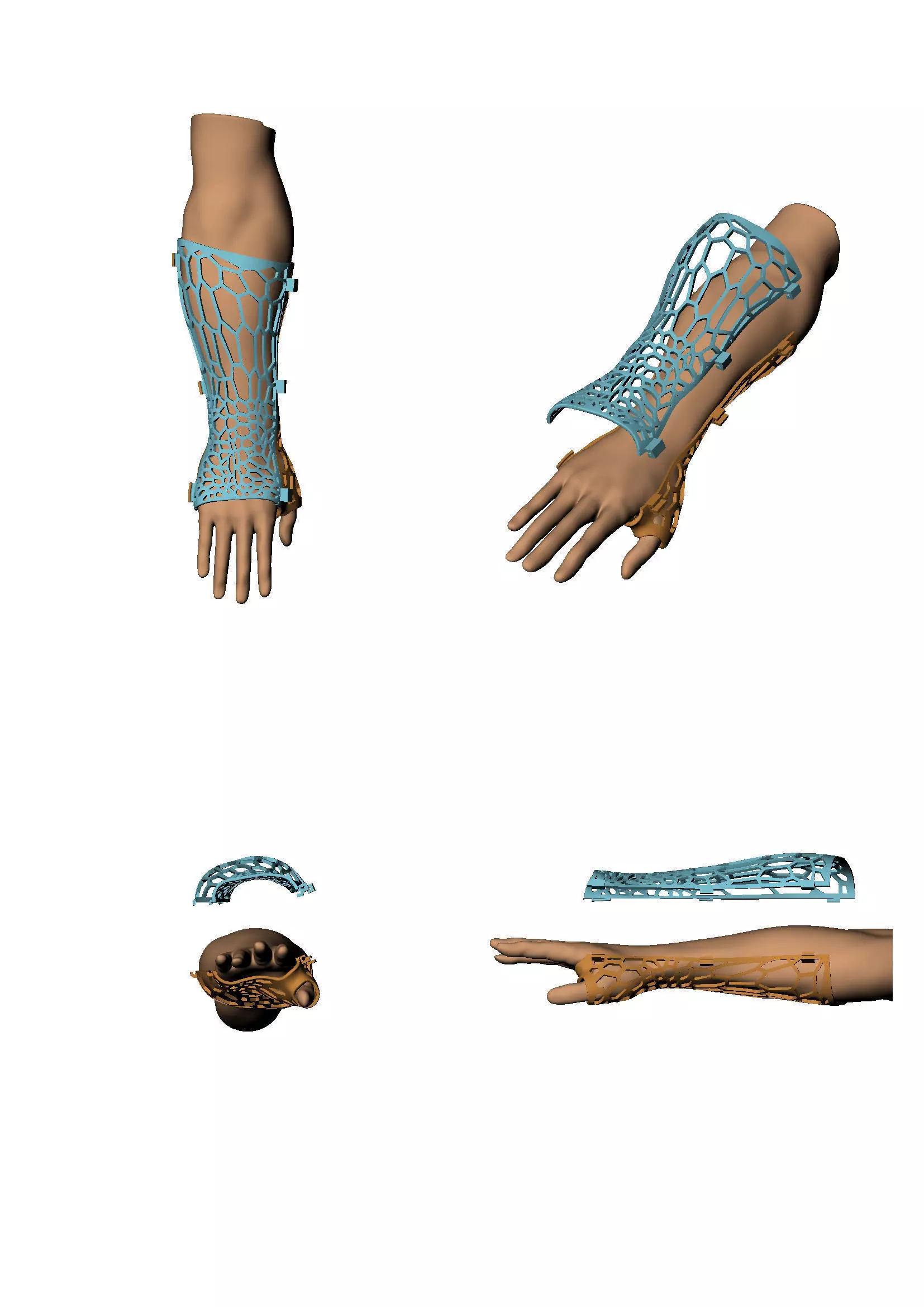 Technology  Medical   on broken arm   3D print model_0