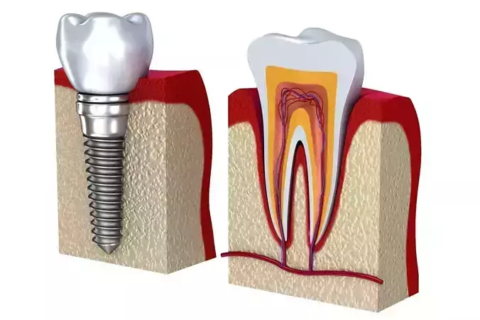 Anatomy of healthy teeth and dental implant in jaw bone 3D model