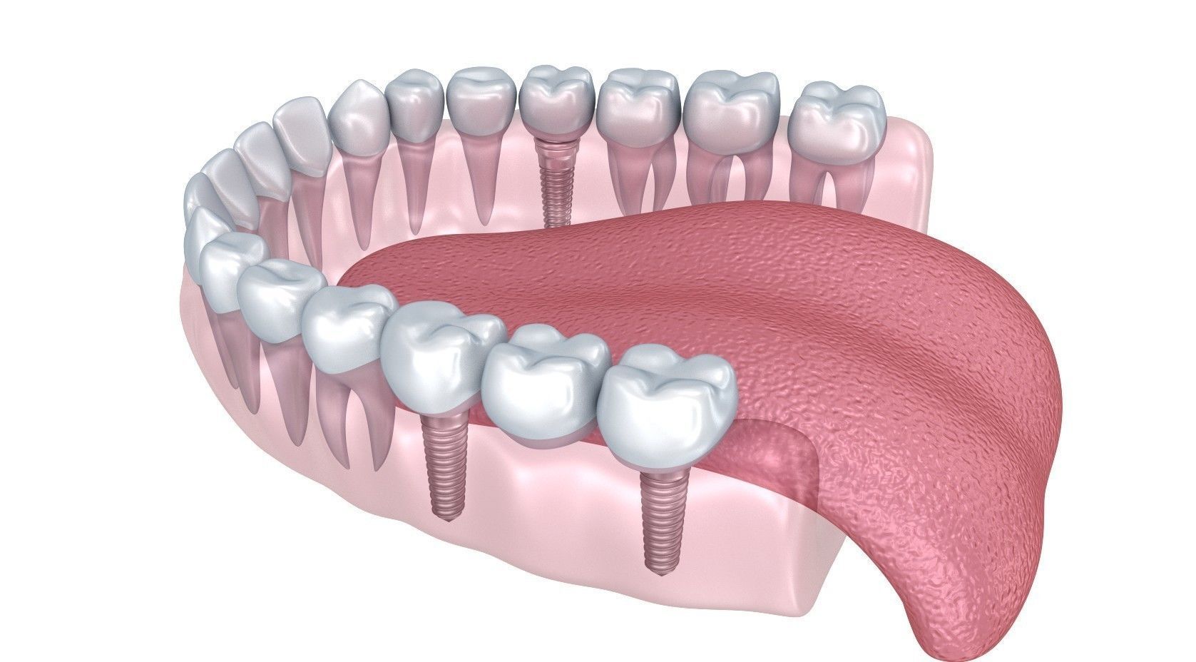 Human Lower teeth crown and dental implant  3D model_7