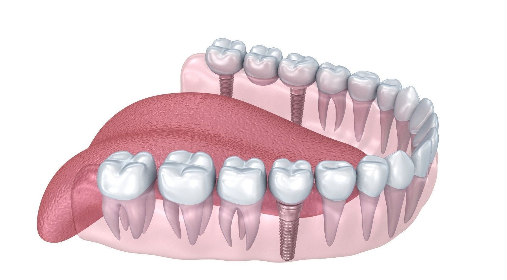 Human Lower teeth crown and dental implant  3D model_4