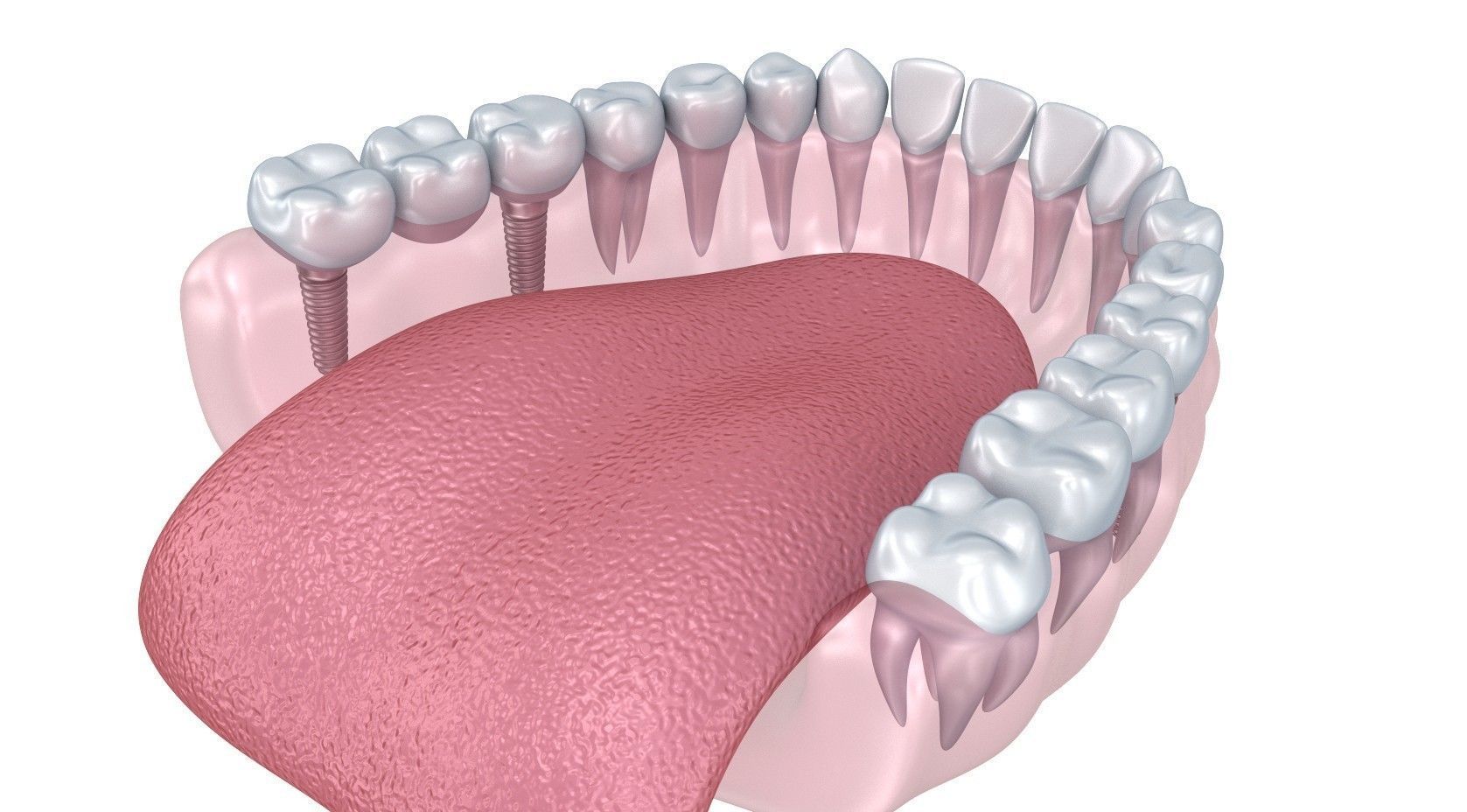 Human Lower teeth crown and dental implant  3D model_6