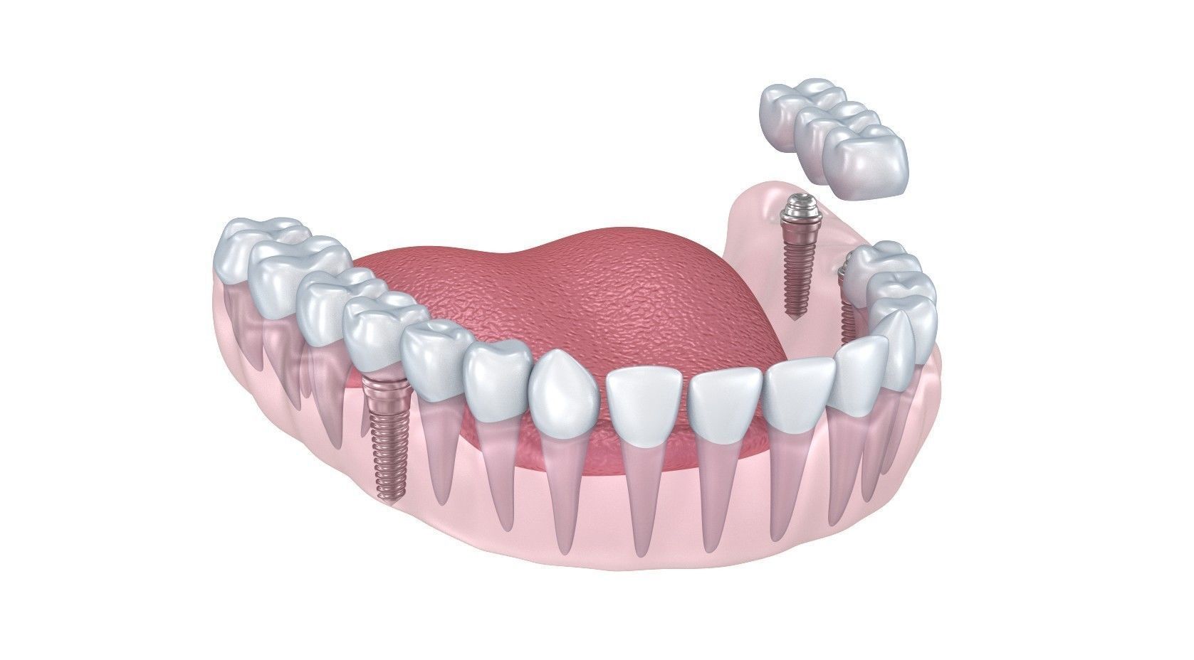 Human Lower teeth crown and dental implant  3D model_2