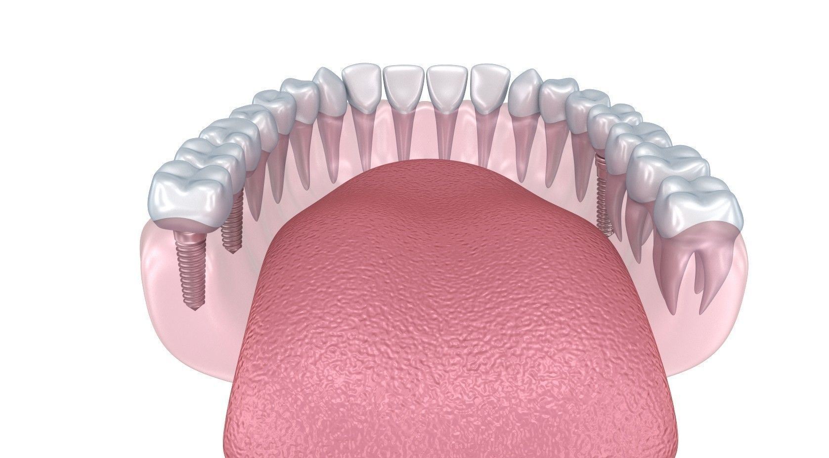 Human Lower teeth crown and dental implant  3D model_5
