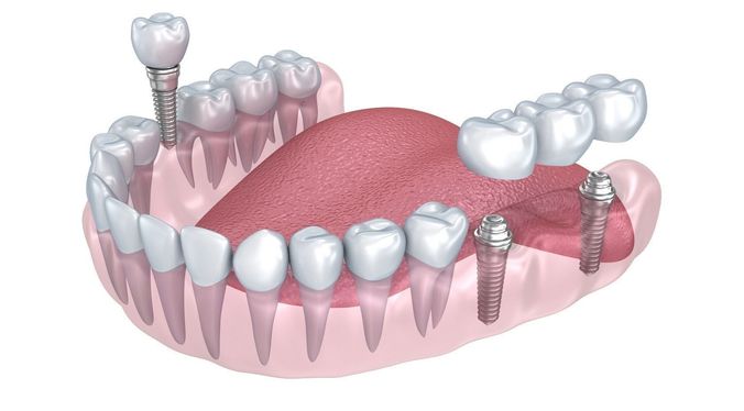 Human Lower teeth crown and dental implant  3D model