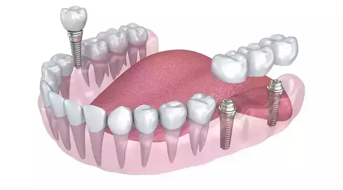 Human Lower teeth crown and dental implant  3D model