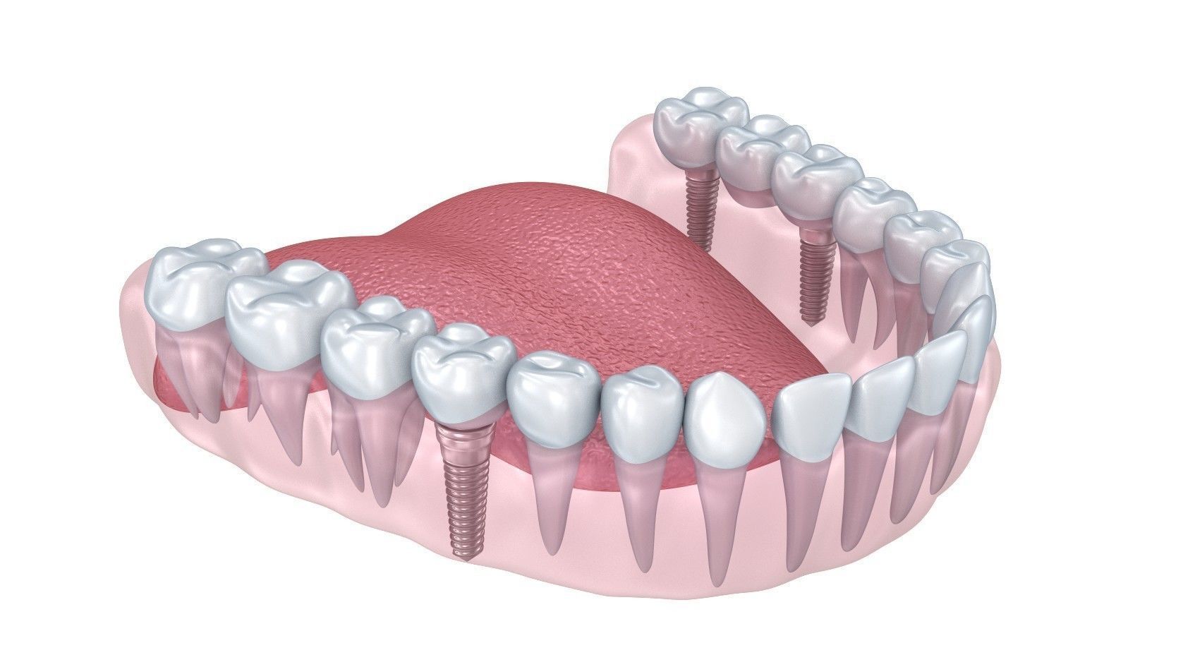Human Lower teeth crown and dental implant  3D model_3