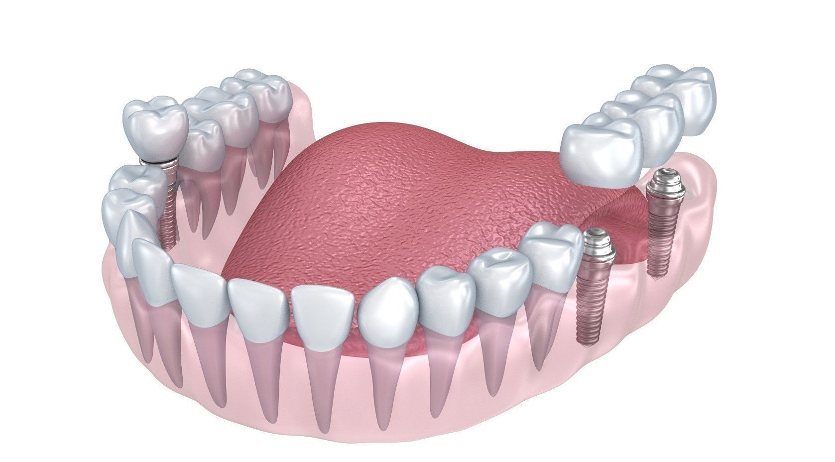 Human Lower teeth crown and dental implant  3D model_1