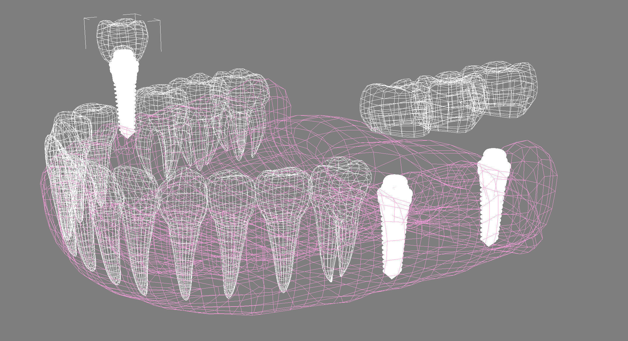Human Lower teeth crown and dental implant  3D model_12