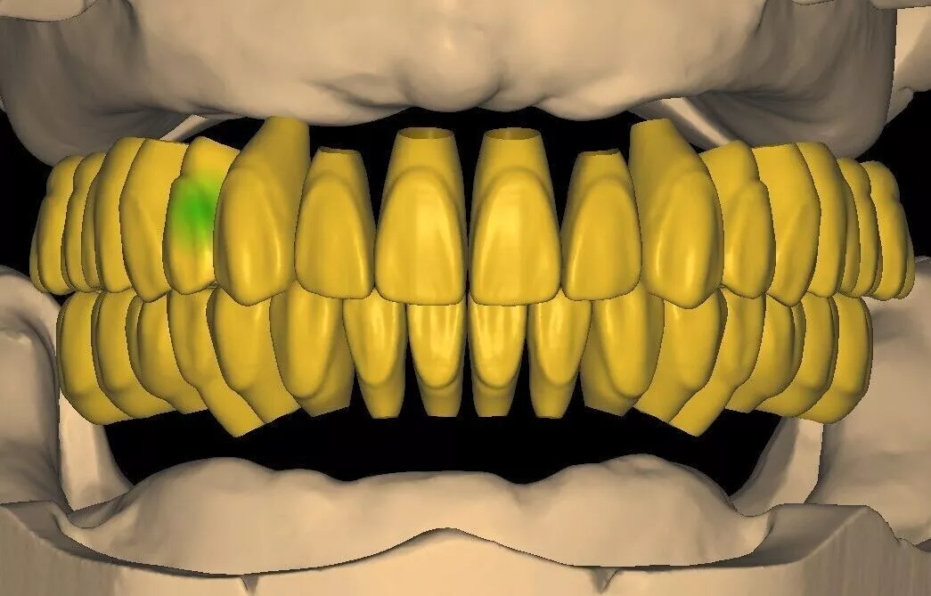 Free Exocad Tooth Library 4 Free 3D print model
