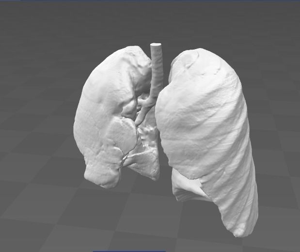 Exudative Pleurisy - female 3D model_2