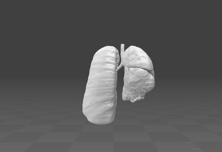 Exudative Pleurisy - female 3D model_1