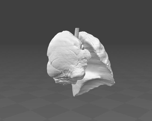 Exudative Pleurisy - female 3D model_4