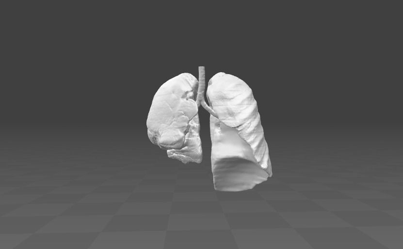 Exudative Pleurisy - female 3D model_0