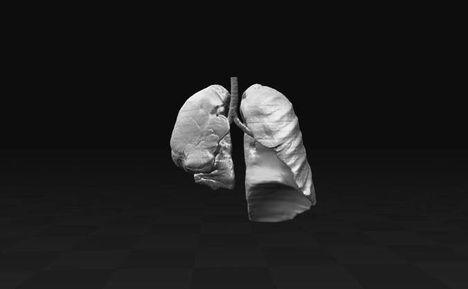 Exudative Pleurisy - female 3D model