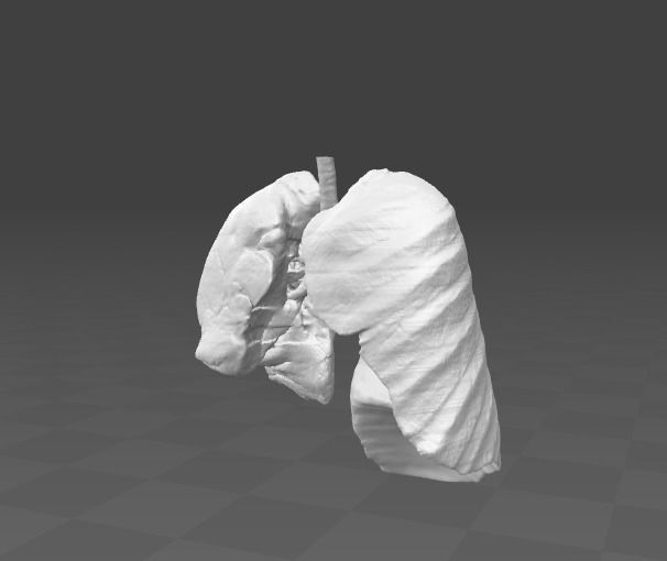 Exudative Pleurisy - female 3D model_3