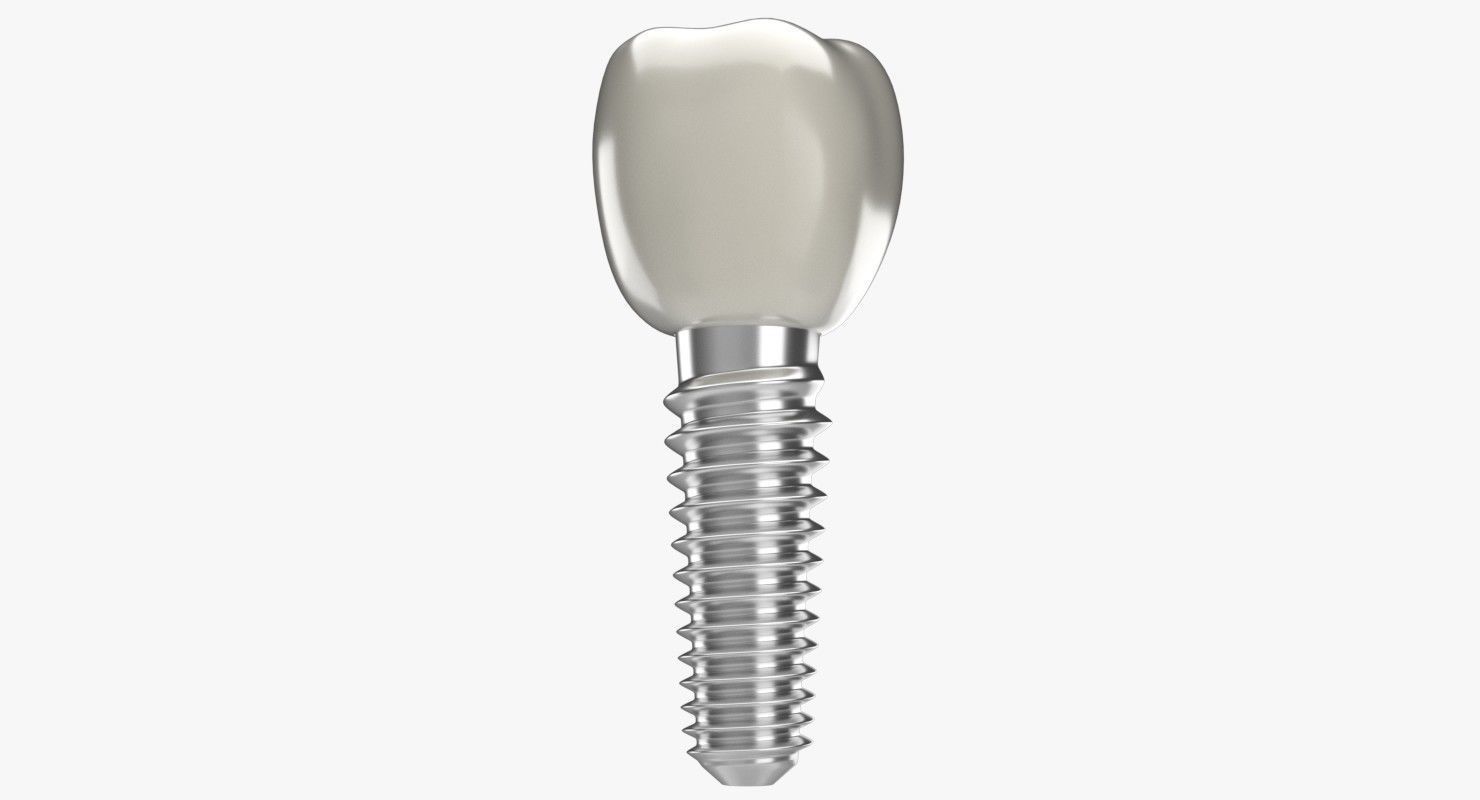 Tooth Implant 3D model_1