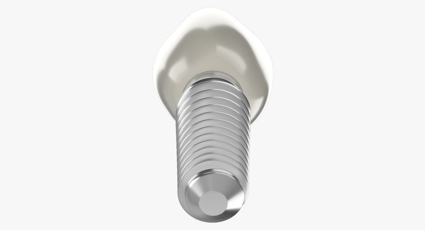 Tooth Implant 3D model_3