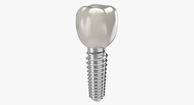 Tooth Implant 3D model