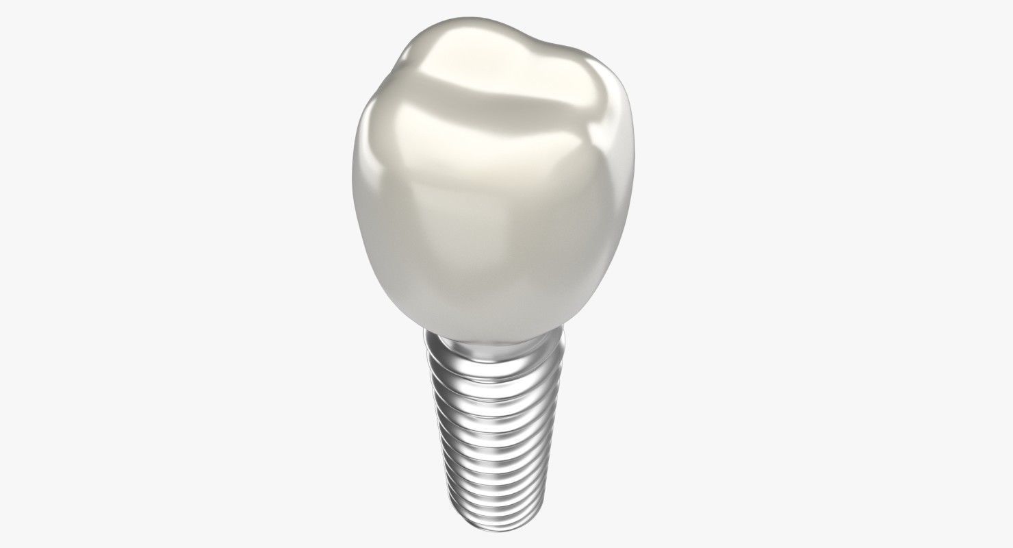 Tooth Implant 3D model_2