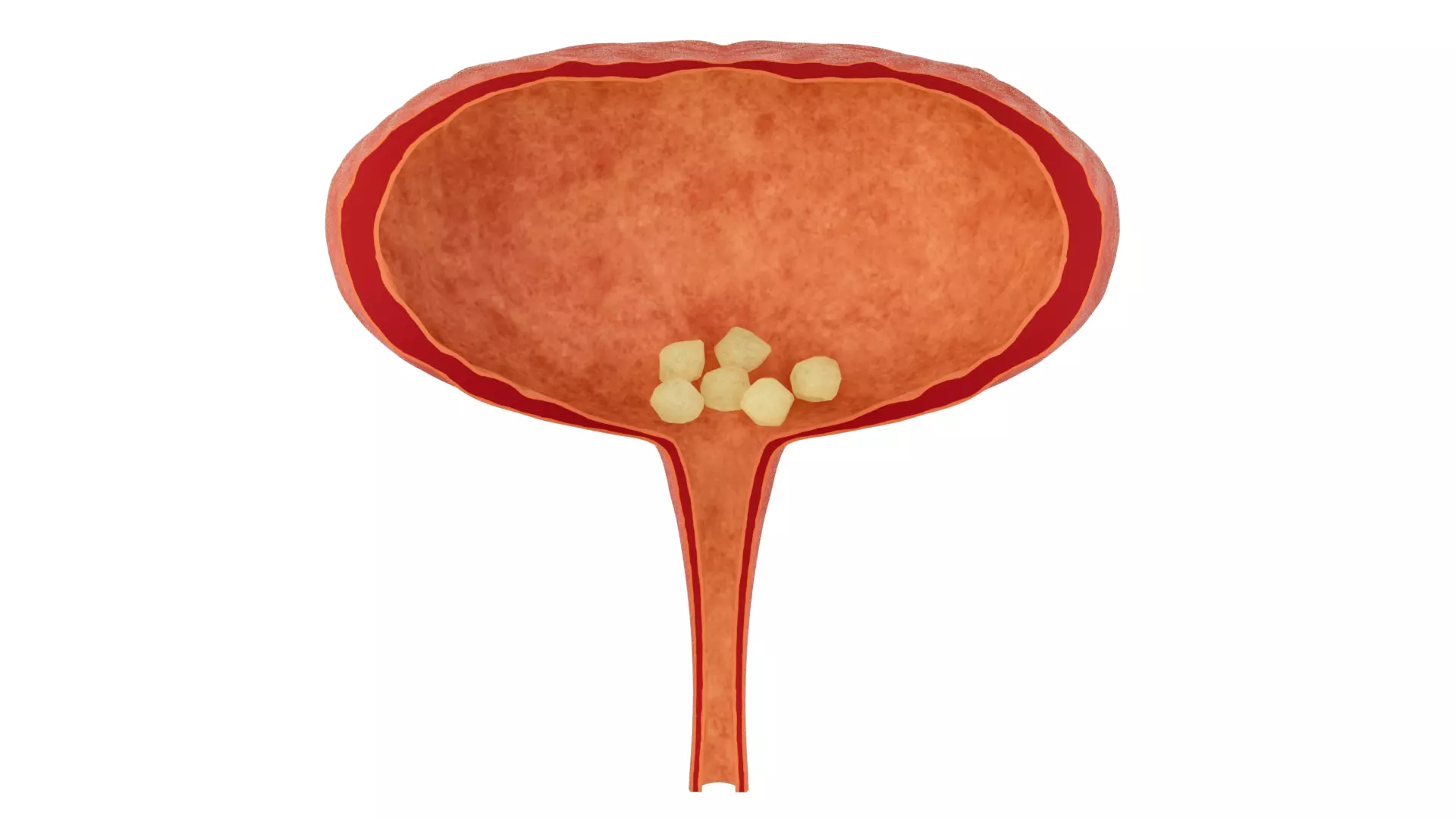 Bladder stones cystitis urinary system diseases 3D model