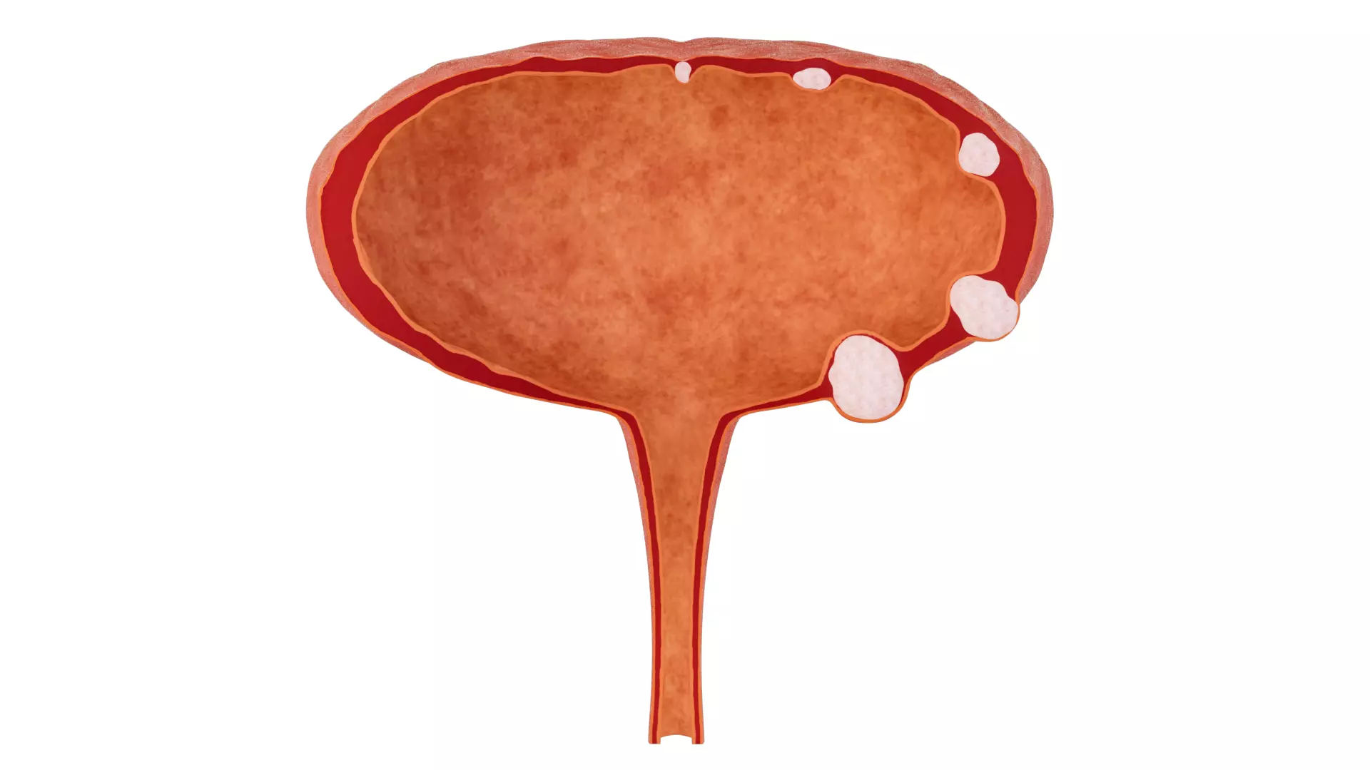 Bladder wall stones bladder anatomy and lesions 3D model