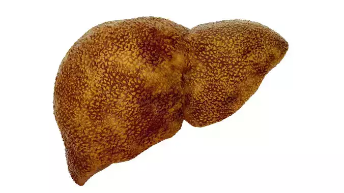 Cirrhosis liver disease digestive system organs 3D model